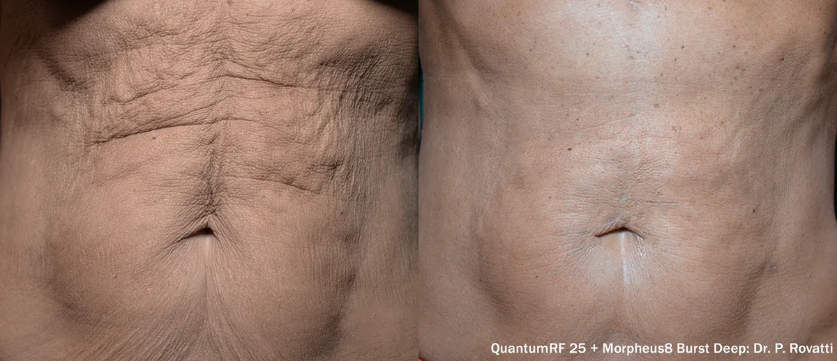 Supplied before-and-after view of the abdomen