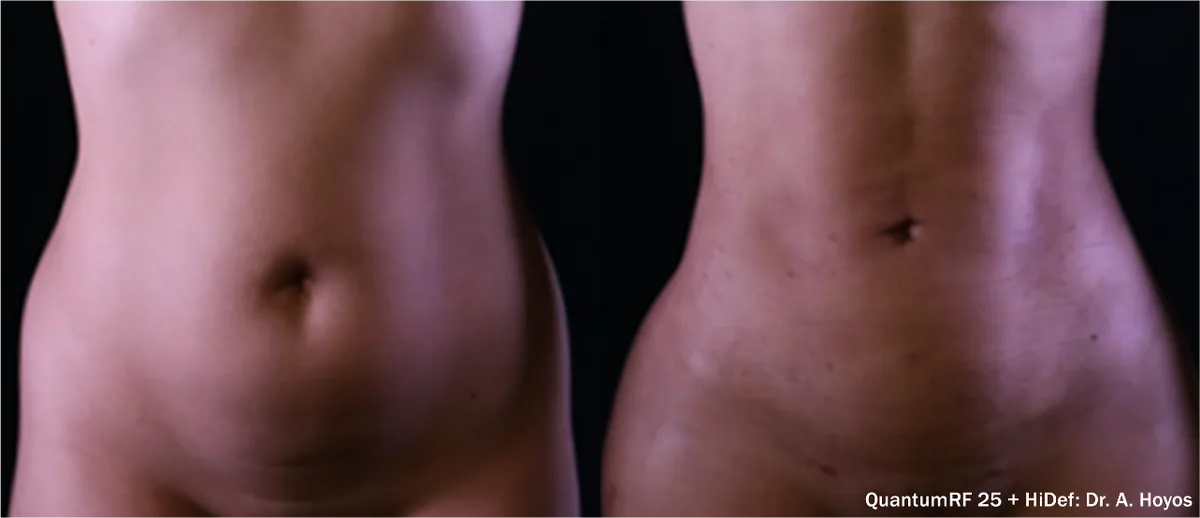 Supplied before-and-after view of the abdomen
