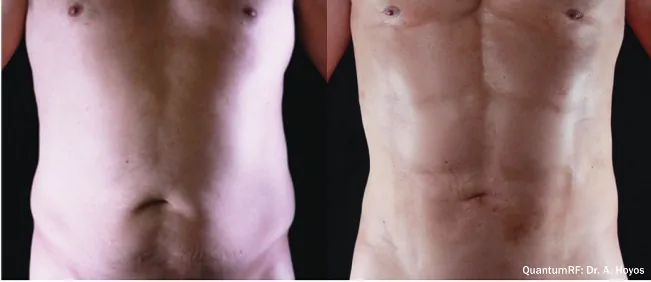 Supplied before-and-after view of the abdomen