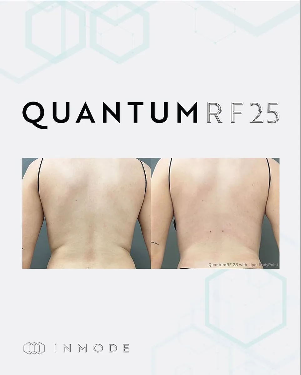 Supplied before-and-after view of the lower back