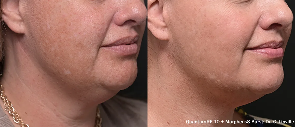 Supplied before-and-after view of the lower face