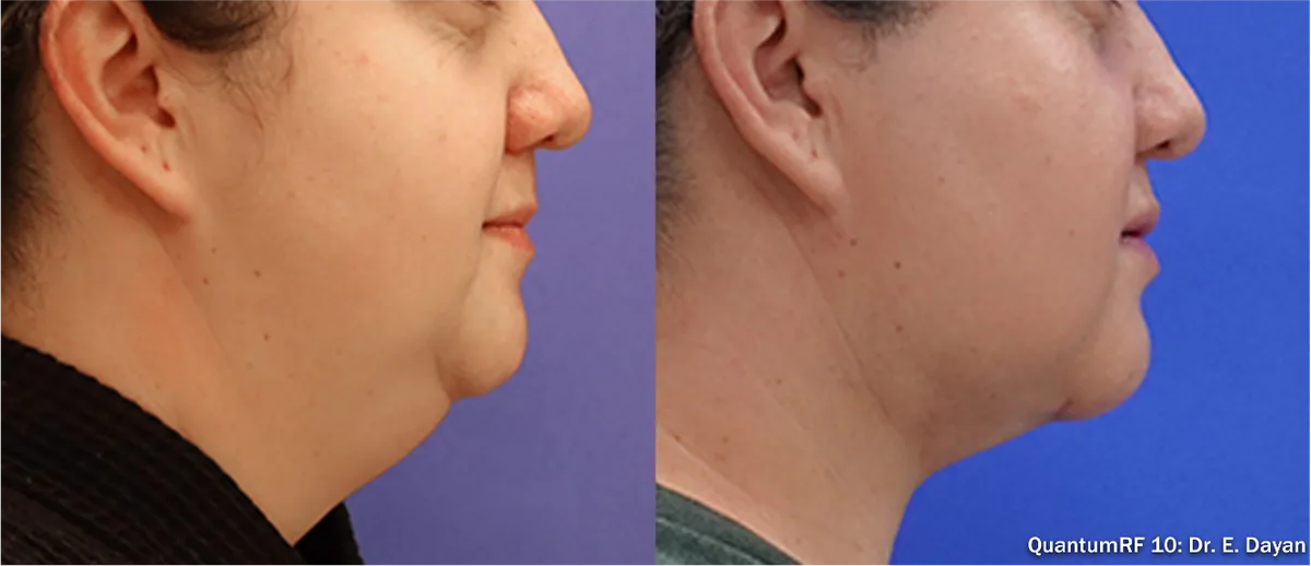 Supplied before-and-after view of the lower face