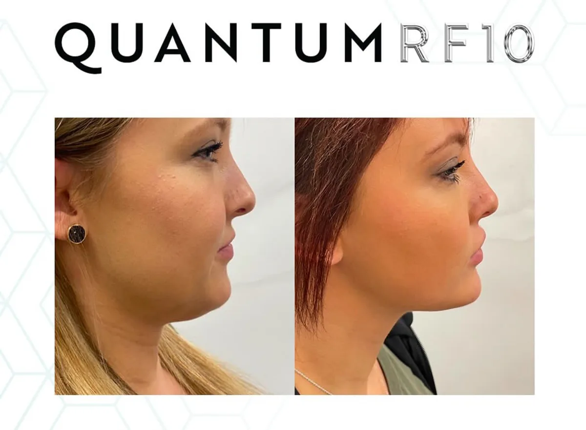 Supplied before-and-after view of the lower face