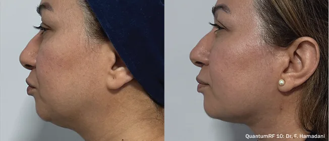 Supplied before-and-after view of the lower face