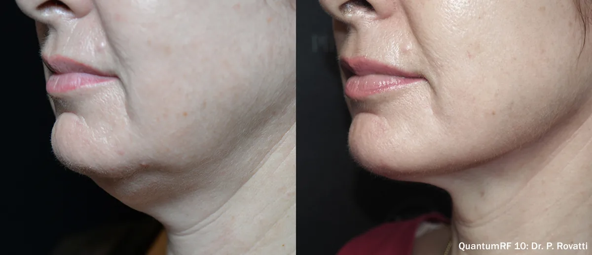 Supplied before-and-after view of the lower face and jawline