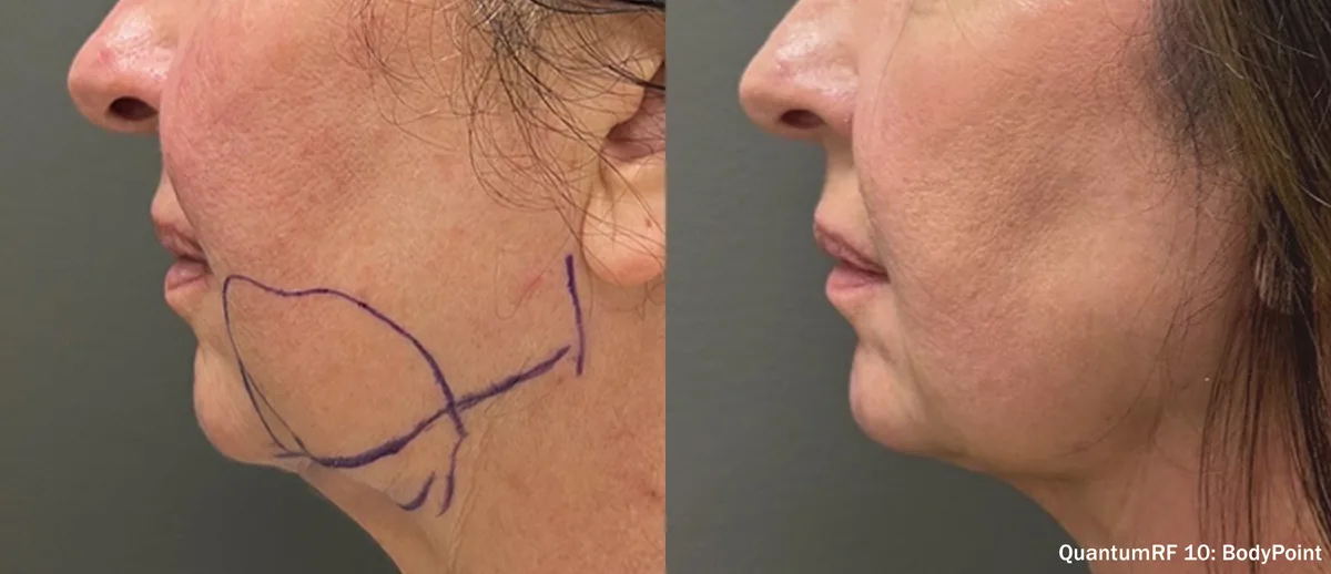 Supplied before-and-after view of the lower face