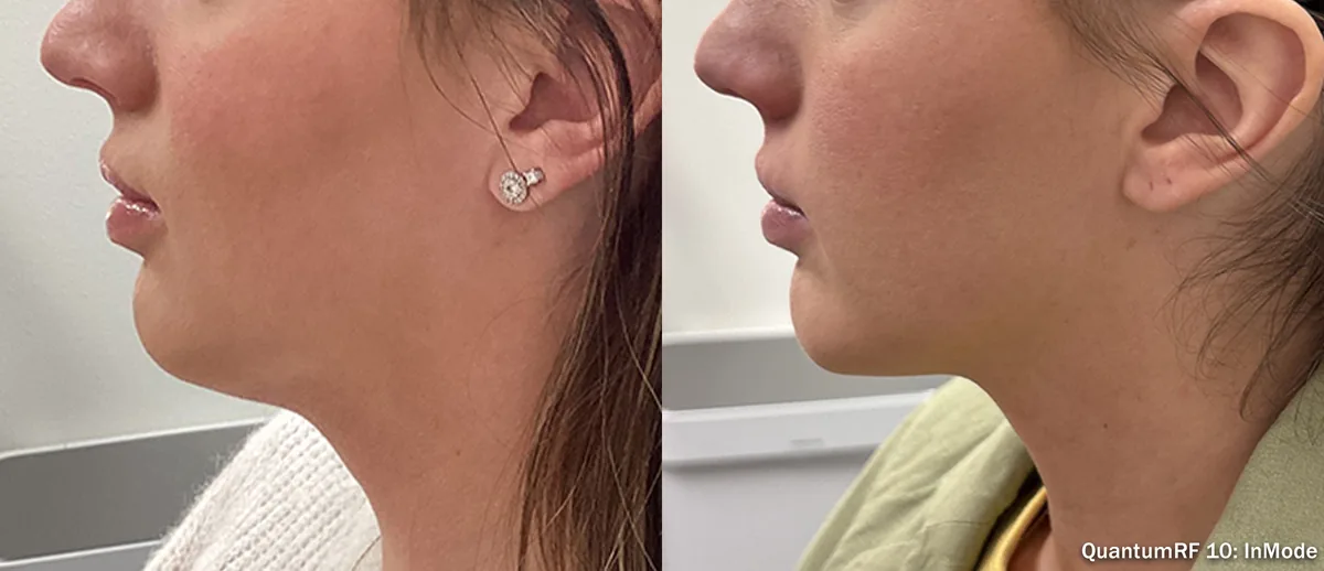 Supplied before-and-after view of the lower face