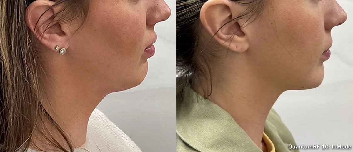 Supplied before-and-after view of the lower face