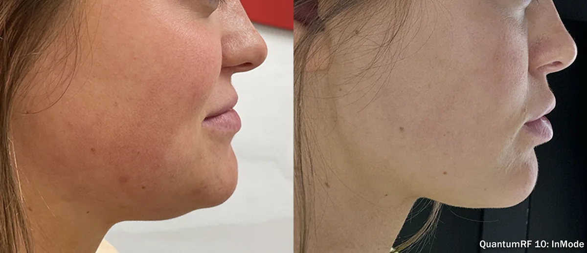 Supplied before-and-after view of the lower face