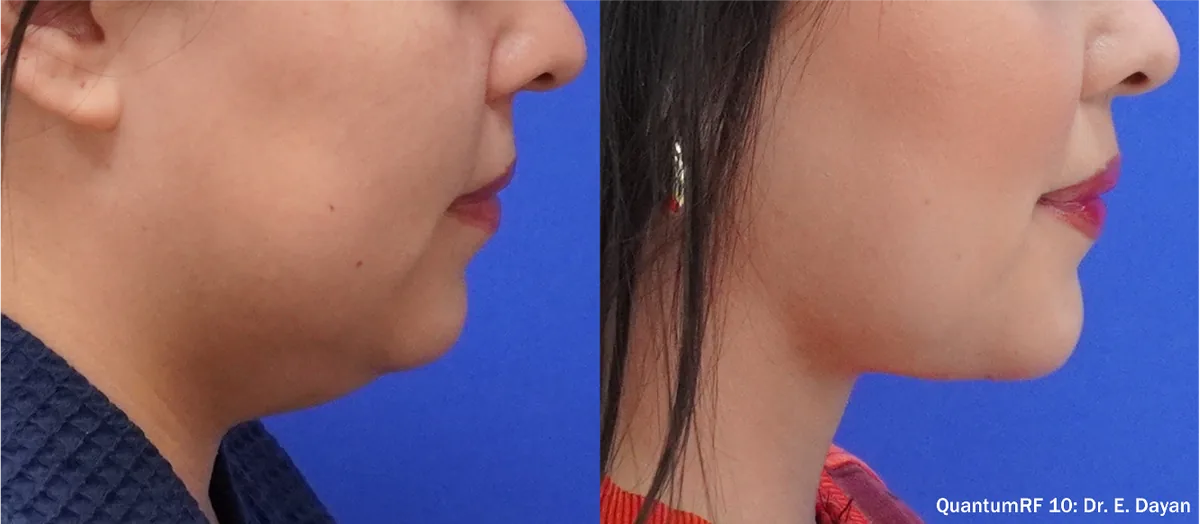 Supplied before-and-after view of the lower face
