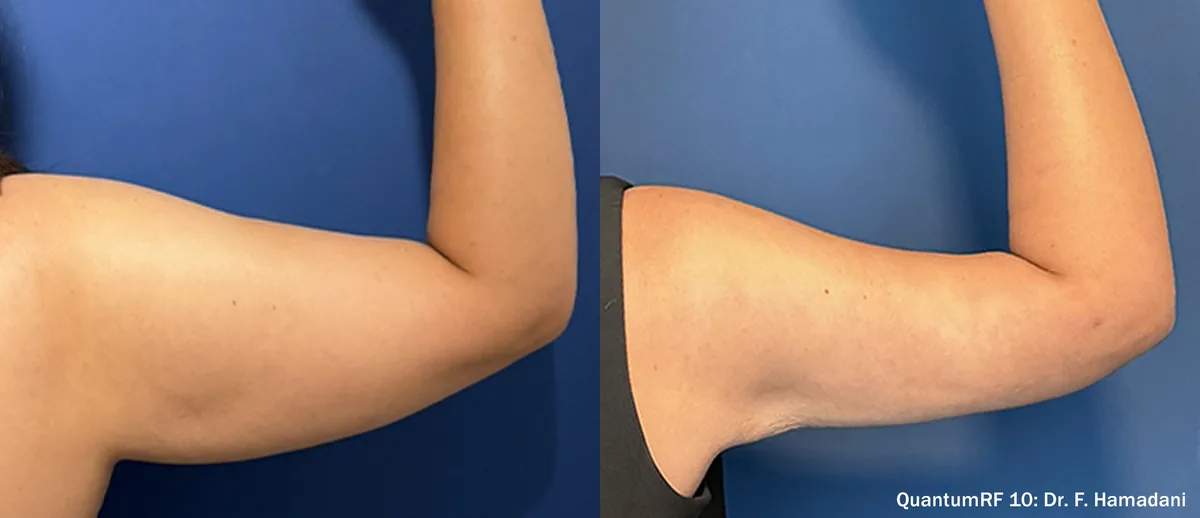 Supplied before-and-after view of the upper arm