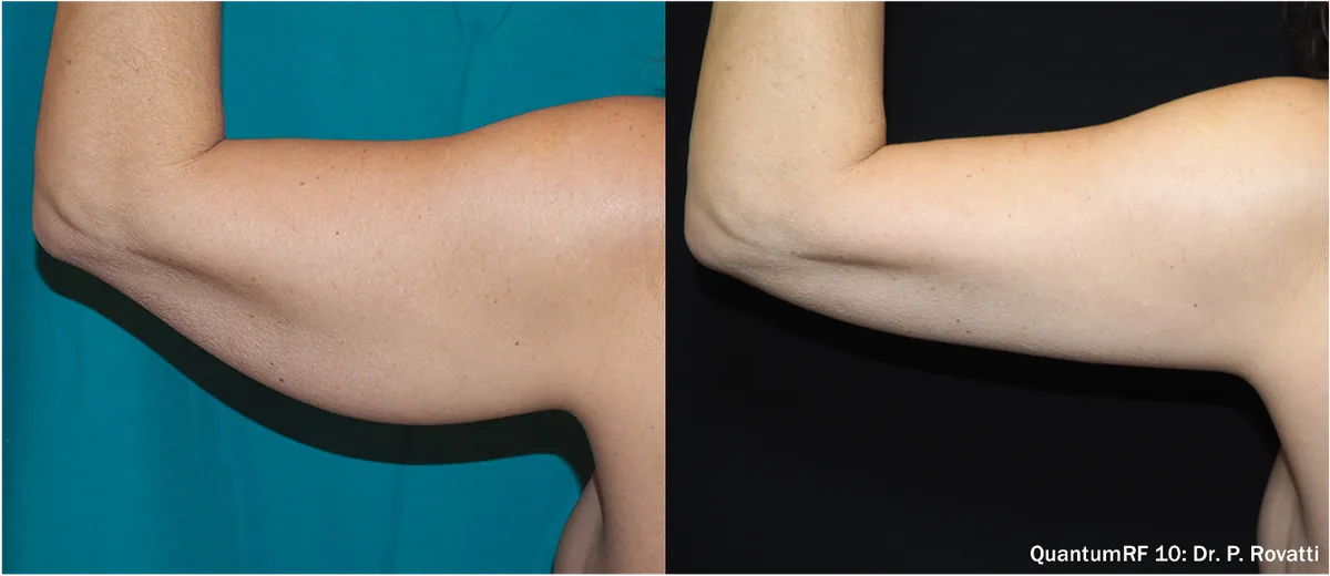 Supplied before-and-after view of the upper arm